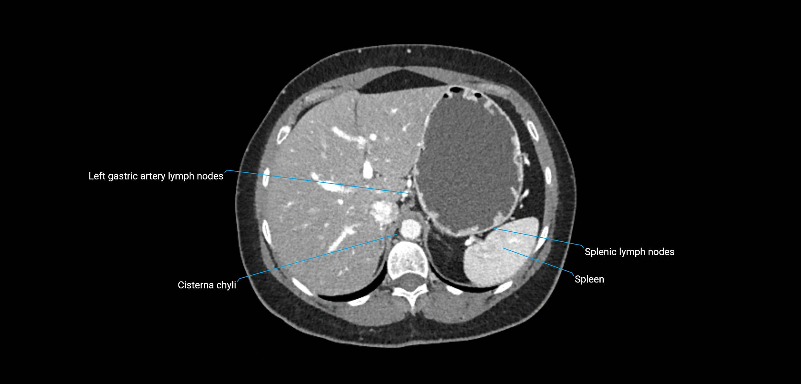 CT ct abdominal lymph nodes  axial cross sectional anatomy  enchanced radiology image -img-00002-00120.webp